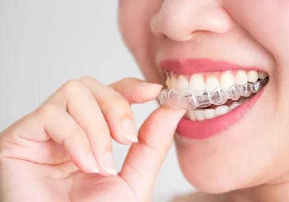 Invisalign Routine Life with Invisalign: How Clear Aligners Fit into Your Daily Routine ...