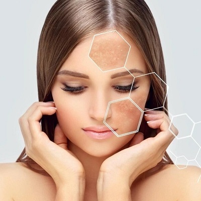 melasma-treatment-in-islamabadbRkJNPe
