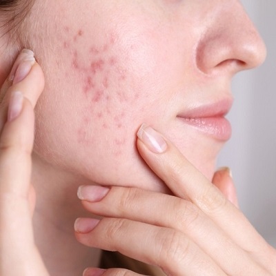 Acne-scar-in-Islamabad
