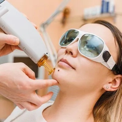 laser-mole-removal-in-islamabad