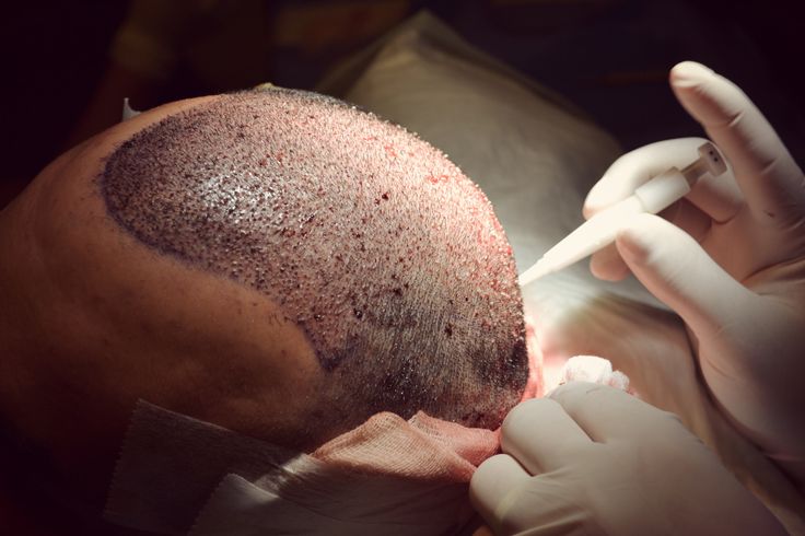 Hair-Transplant-Cost-in-Islamabad9wrzVmTJ