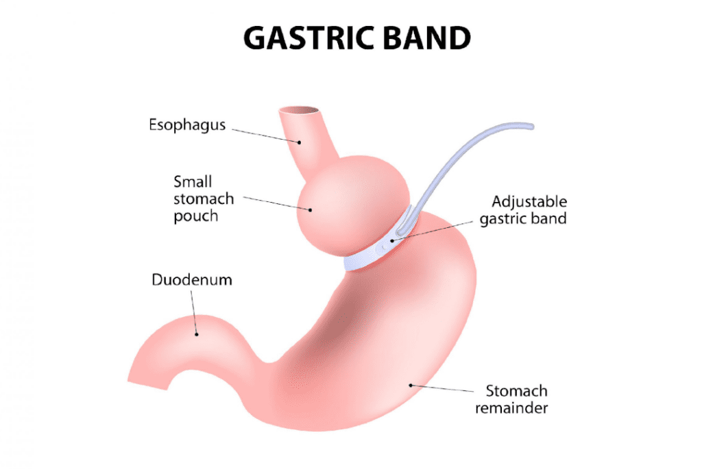 gastric-banding