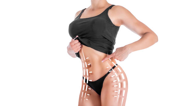 Liposuction-in-Riyadh-11