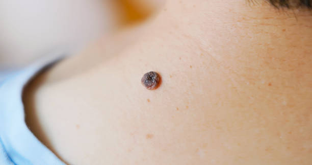 Warts-Removal-Treatment-in-Riyadh-11
